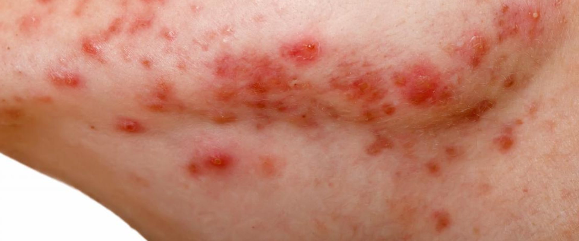 Menstrual Cycle and Acne Causes, Symptoms, and Treatment