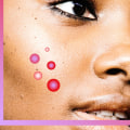 Stress Management for Adult Acne Treatment