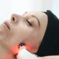 Laser Therapy for Acne Scars: A Comprehensive Overview