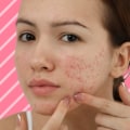Herbal Remedies for Acne: A Comprehensive Overview