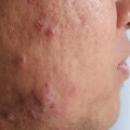 Understanding Poor Diet and Acne - A Comprehensive Overview