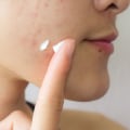 Creams and Lotions for Acne Scars