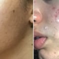 Herbs for Adult Acne Treatment