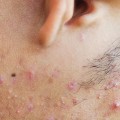 Exploring the Family History of Acne