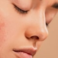 How to Get Enough Sleep and Prevent Acne
