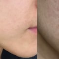 Vitamin B3 for Acne Treatment
