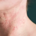 Eczema and Acne: A Look at the Causes, Symptoms, and Treatments