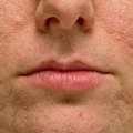 Creams and Lotions for Acne Scars: An In-Depth Look