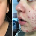 Serums and Oils for Acne Scars: A Complete Overview
