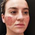 Laser Therapy for Acne Scar Removal