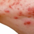 Hormonal Imbalances and Acne: Causes and Effects