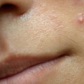 Antibiotics for Acne: Exploring Treatment Options