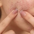 Essential Oils for Acne: Natural Remedies for Clear Skin