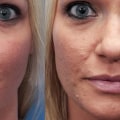 Microdermabrasion for Acne Scars: What You Need to Know
