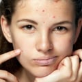 Vitamin A for Acne Treatment: Benefits and How to Use
