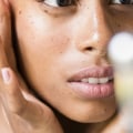 Topical Retinoids for Adult Acne: A Guide to Medical Treatments