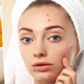 Turmeric for Acne Treatment: Natural Remedies for Clear Skin