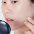 Understanding Hormonal Imbalances and Acne