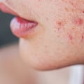 Polycystic Ovary Syndrome and Acne: What You Need to Know