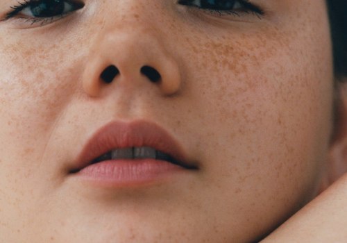 Cosmetics and Acne: A Comprehensive Overview