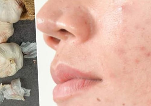 Natural Remedies for Acne: Garlic and Its Benefits