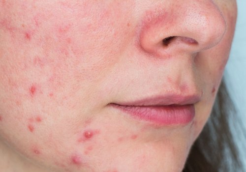 Antibiotics for Adult Acne: A Comprehensive Overview