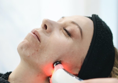 Laser Therapy for Acne Scars: A Comprehensive Overview