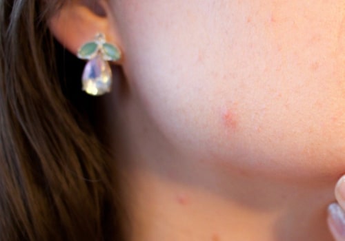 Exploring the Genetics Behind Acne