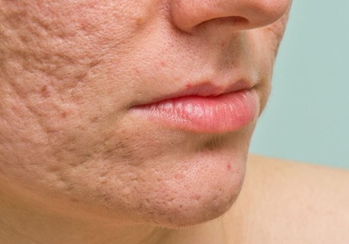 Microdermabrasion for Acne Scars: A Comprehensive Overview