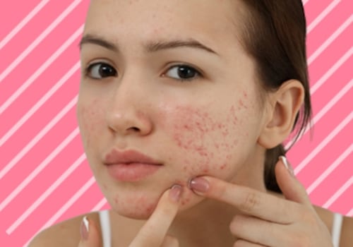 Herbal Remedies for Acne: A Comprehensive Overview