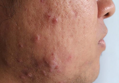 Understanding Poor Diet and Acne - A Comprehensive Overview