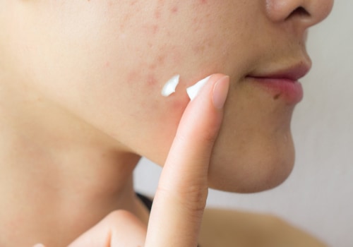 Creams and Lotions for Acne Scars
