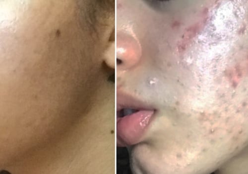 Herbs for Adult Acne Treatment