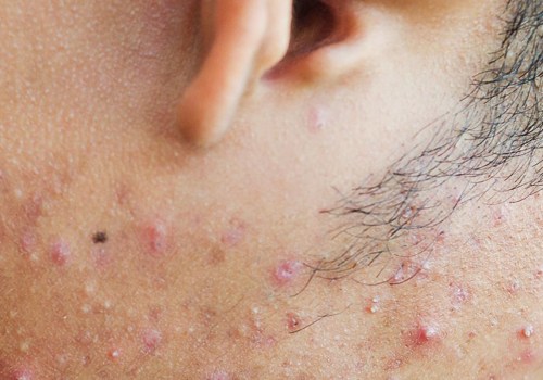 Exploring the Family History of Acne