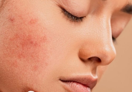 How to Get Enough Sleep and Prevent Acne