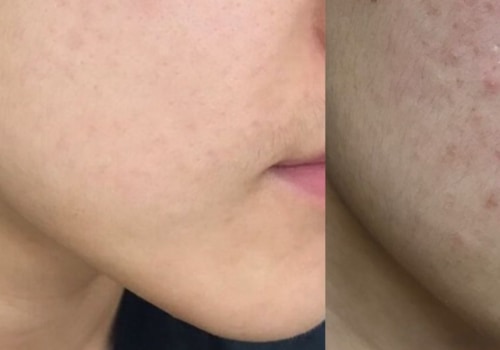 Vitamin B3 for Acne Treatment