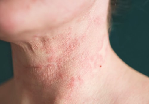 Eczema and Acne: A Look at the Causes, Symptoms, and Treatments