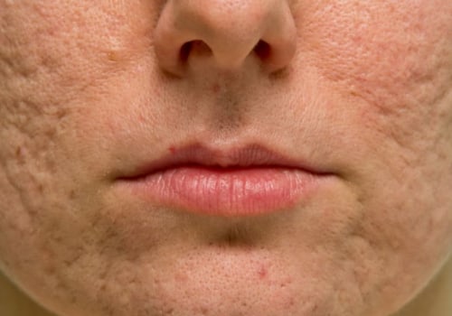 Creams and Lotions for Acne Scars: An In-Depth Look