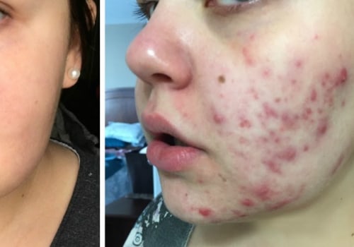 Serums and Oils for Acne Scars: A Complete Overview