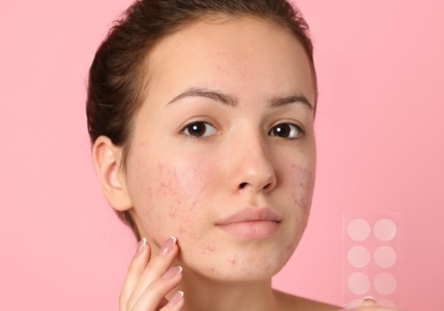 Everything You Need to Know About Puberty and Acne