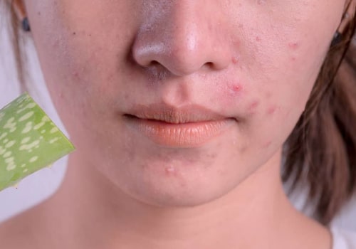 Aloe Vera For Acne Scars: Everything You Need To Know