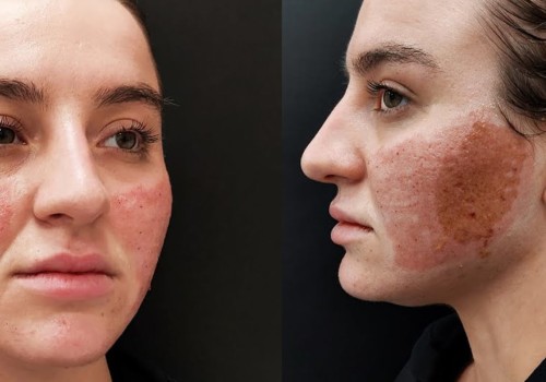 Laser Therapy for Acne Scar Removal
