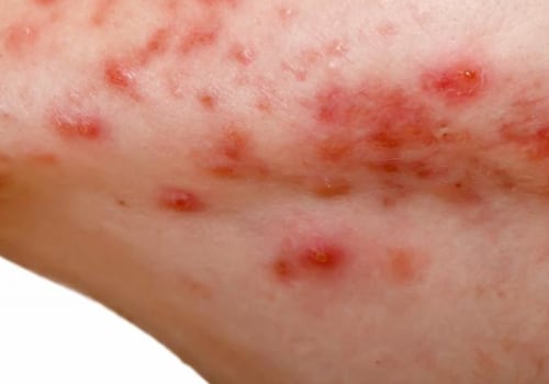 Hormonal Imbalances and Acne: Causes and Effects