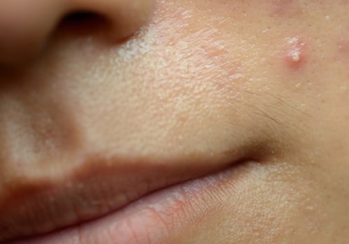 Antibiotics for Acne: Exploring Treatment Options