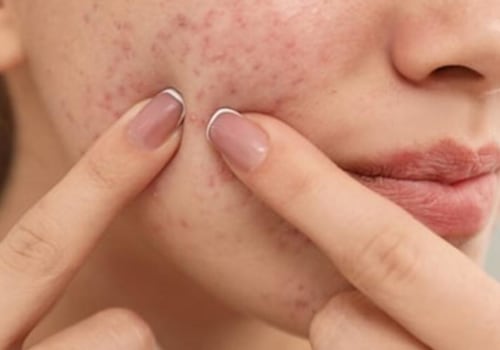 Essential Oils for Acne: Natural Remedies for Clear Skin