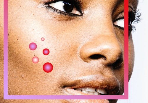 Identifying Personal Triggers for Breakouts