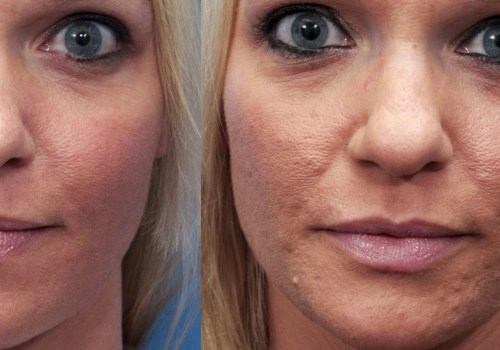Microdermabrasion for Acne Scars: What You Need to Know