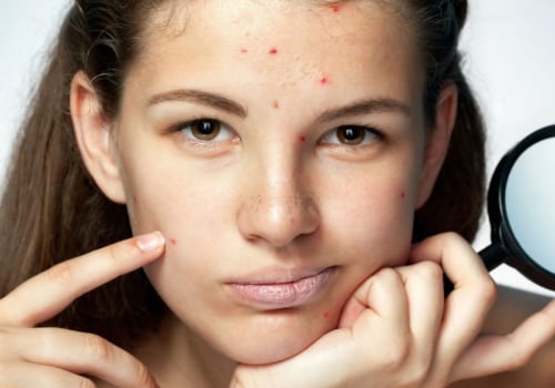 Vitamin A for Acne Treatment: Benefits and How to Use
