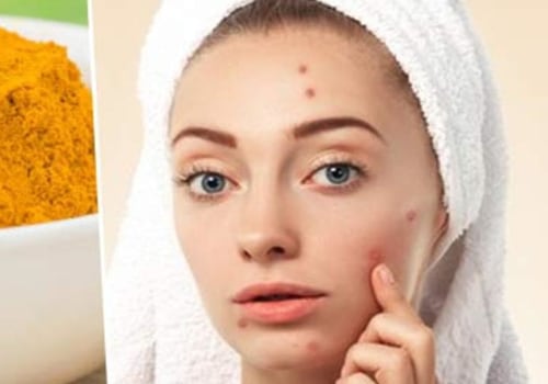Turmeric for Acne Treatment: Natural Remedies for Clear Skin