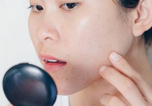 Understanding Hormonal Imbalances and Acne
